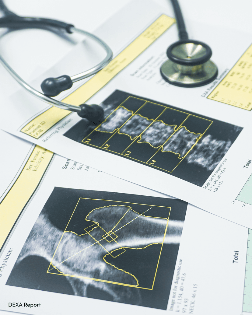 Bone Density Scans in Perimenopause and Menopause: Why They Matter More Thank You Think